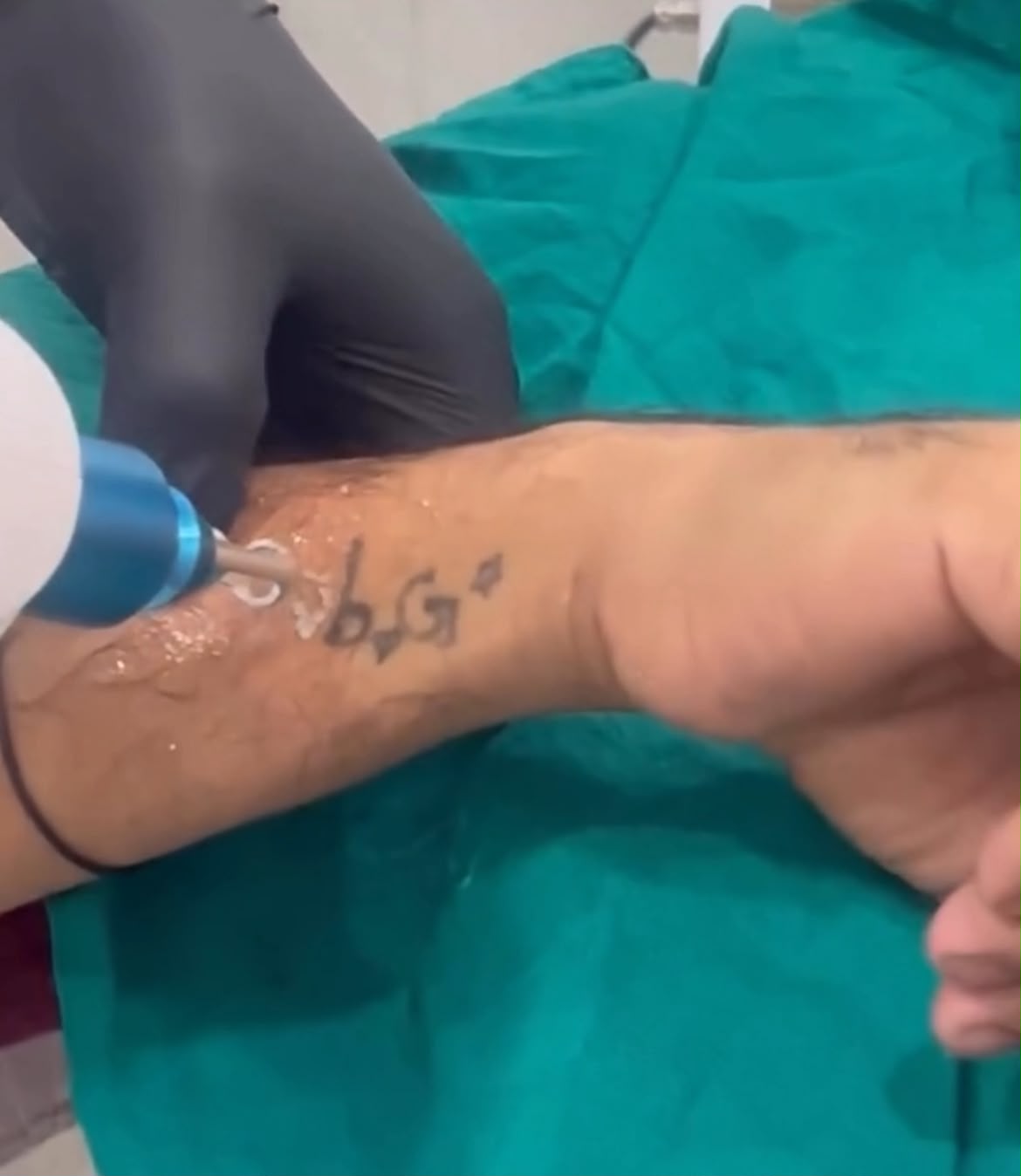 Laser Tattoo Removal — In Session